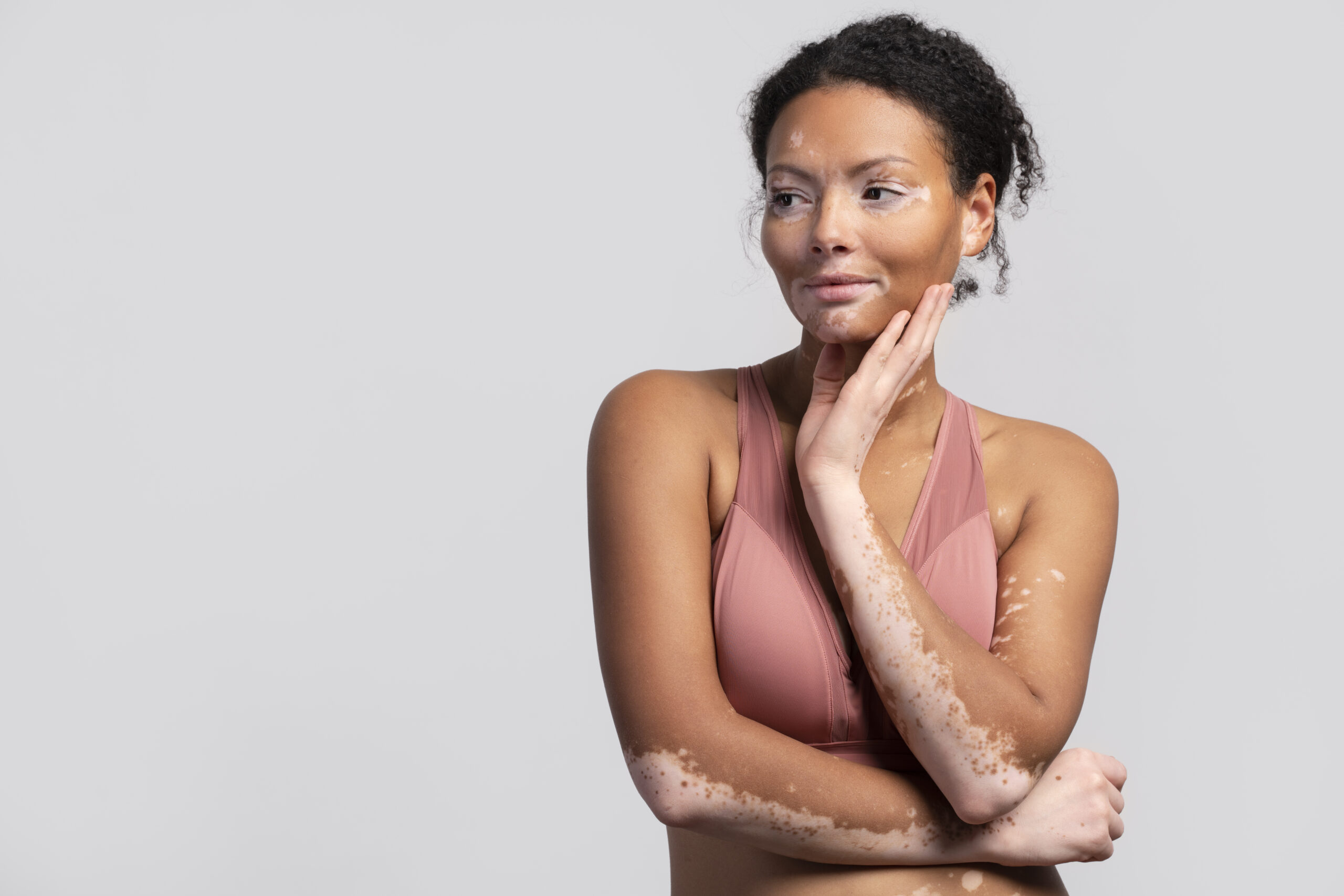 Dia Mundial do Vitiligo: entenda os sintomas, impacto e tratamento da doença que atinge mais de um milhão de brasileiros