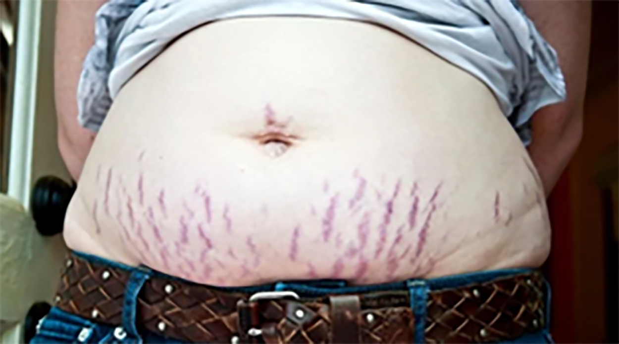 Procedimentos estéticos para estrias na gravidez: pode ou não pode?