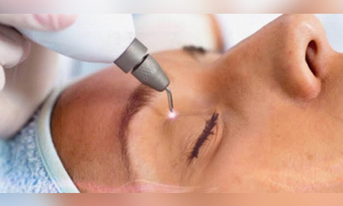 Saiba os benefícios do jato de plasma, procedimento facial sem cortes