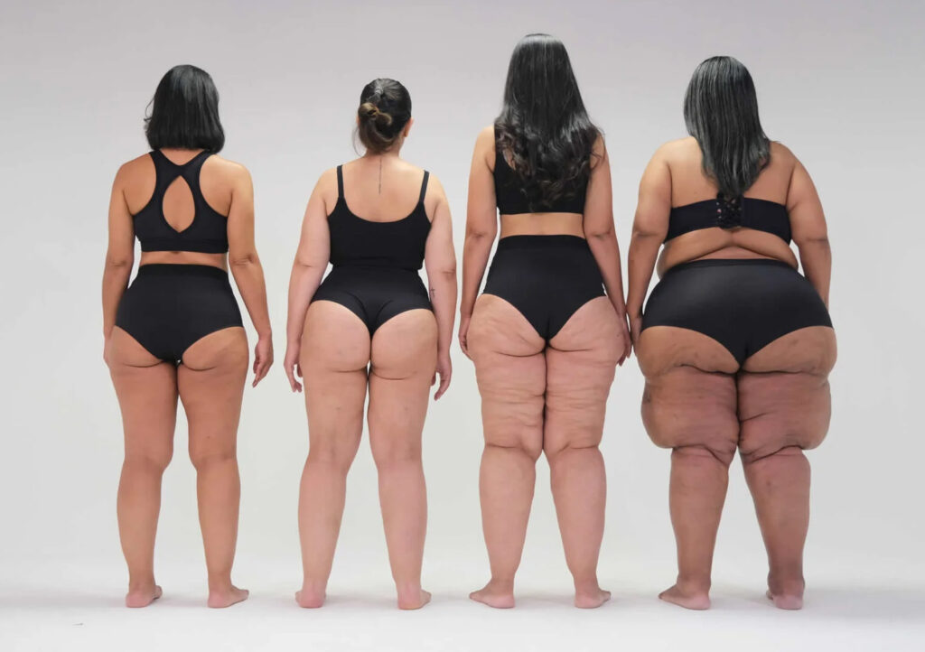 Lipedema Ribeirão chega para conscientizar sobre doença ainda poucoconhecida
