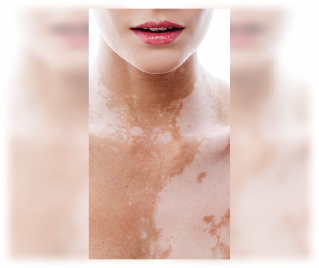 Dia Mundial do Vitiligo: quais os sintomas da doença que afeta mais de 1 milhão de brasileiros
